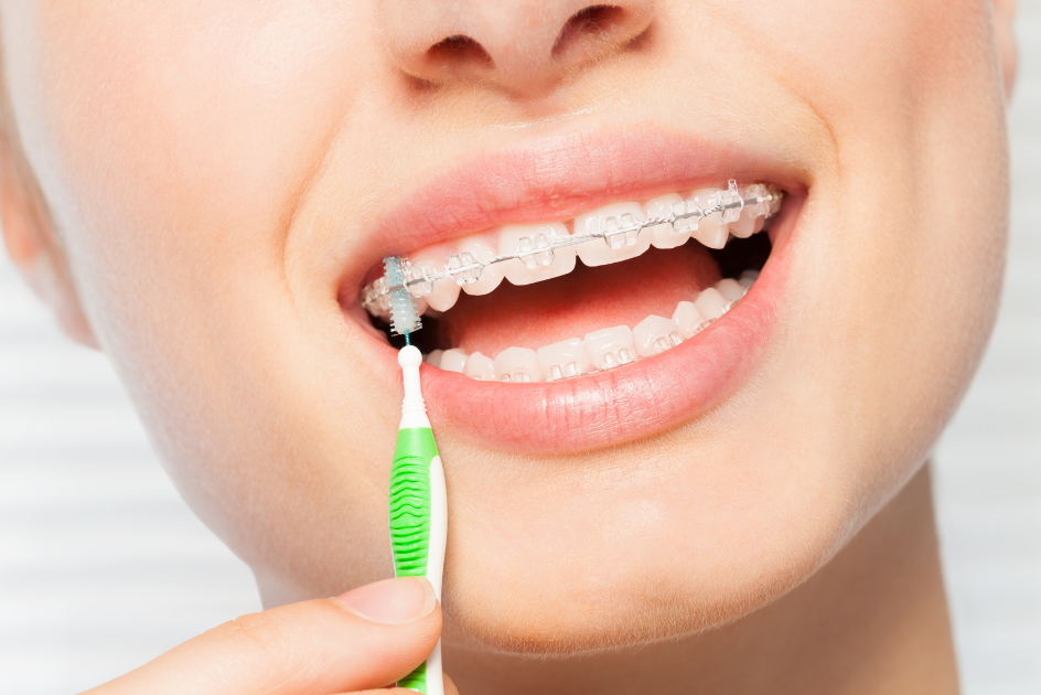 Girl cleaning braces with pick 